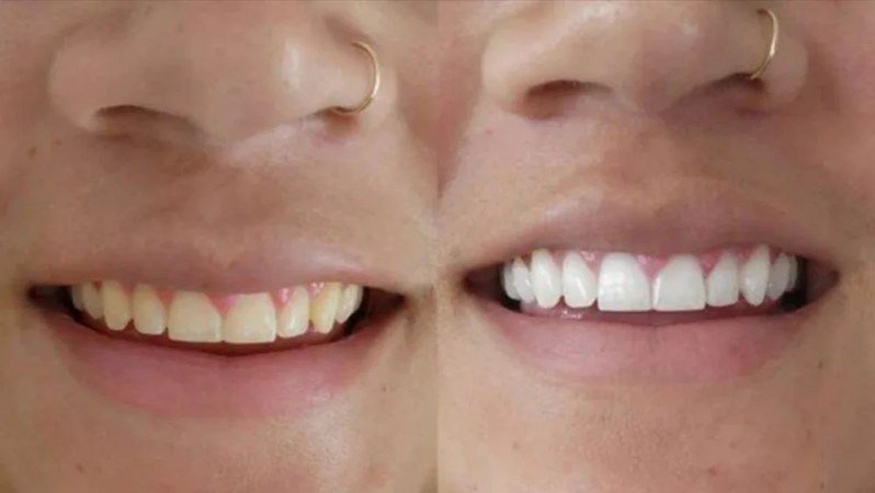 BrightenUp Teeth Whitening — Before and After